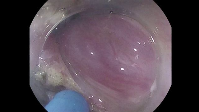 Удаление методом диссекции (ESD) интраэпителиальной неоплазии анального канала (AIN3)