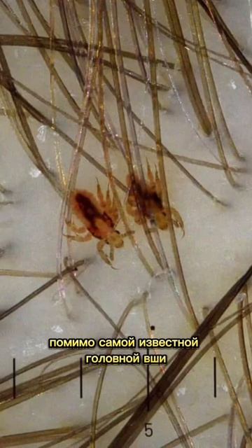 Вы знали это о вшах? смотреть онлайн