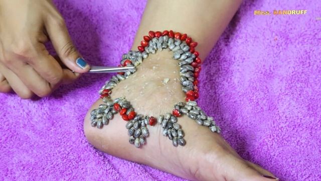 Amazing Million of Ticks Remove on my Foot #1044 смотреть онлайн