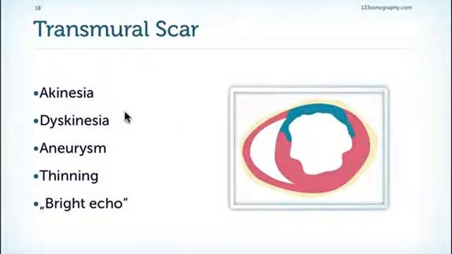 Echocardiography Regional Wall Motion Abnormality - with Examples - Takotsubo Cardiomyopathy смотреть онлайн