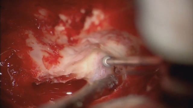 Middle Cranial Fossa Approach for Vestibular Schwannoma Excision смотреть онлайн