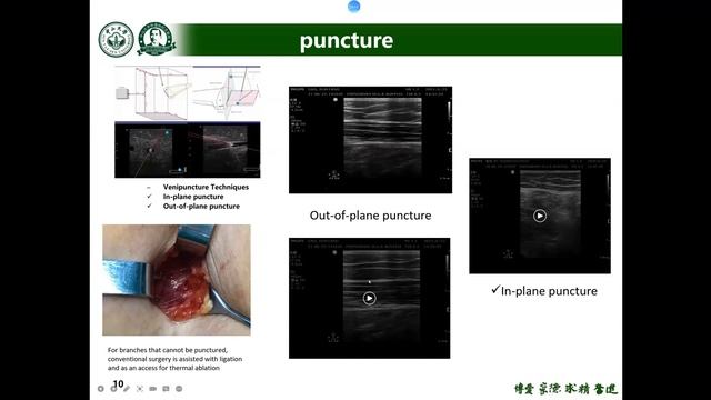 7.4 CCMA Ultrasonographic Manifestations of Microwave Ablation on Varicose Veins by Dr. Kai Huang смотреть онлайн