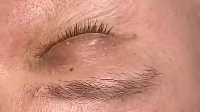 Видалення міліумів 😇 смотреть онлайн