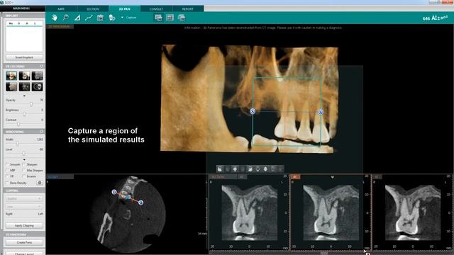 Endo Analysis Root Fracture | Ez3D-i | Vatech смотреть онлайн