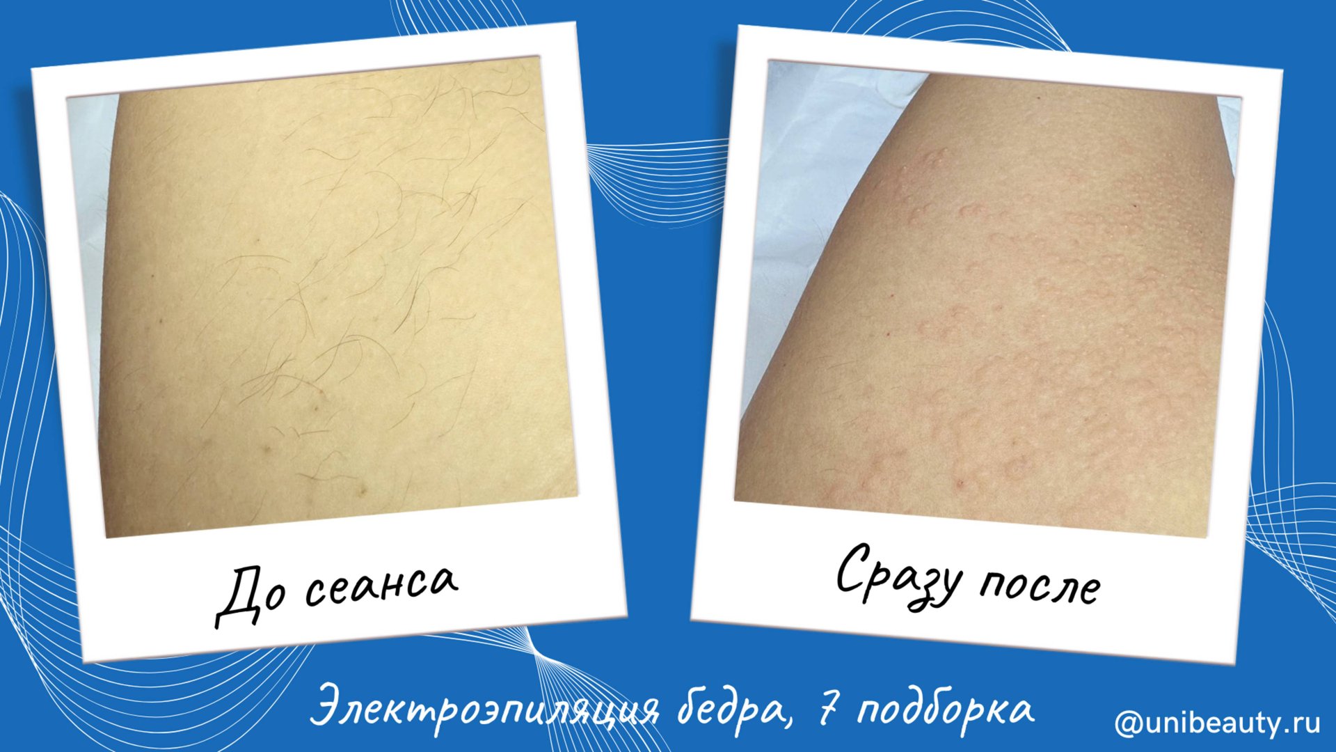 Электроэпиляция бедра методом Blend