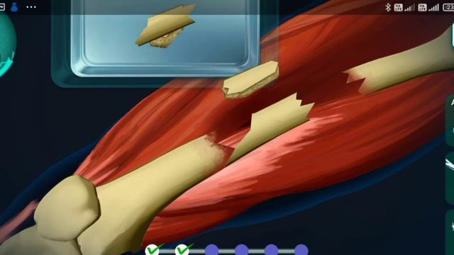 पैर की टूटी हड्डी का ऑपरेशन कैसे किया जाता है | How is a broken leg surgery done? смотреть онлайн