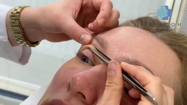 Круговая блефаропластика: пластика верхних и нижних век смотреть онлайн