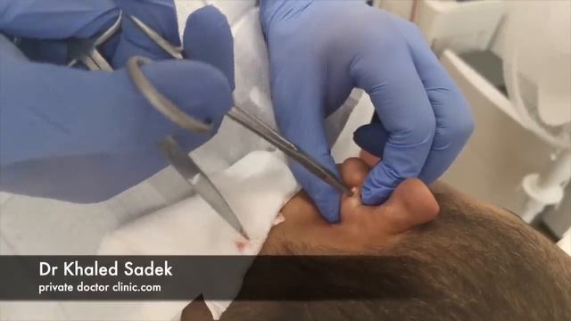 Massive multiple ear cyst Removed. Part 1 of 2 смотреть онлайн