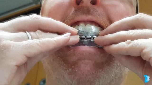 Acusnore Anti Snore 6 Spring Mouth Piece - Tested & Reviewed смотреть онлайн