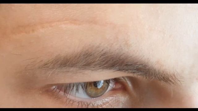 Mederma Cream, Mederma Advanced Scar Gel Review, Mederma Scar Gel, Mederma Gel, Mederma Scar Cream