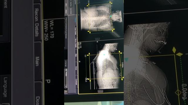 high resolution (HR)chest ct scan смотреть онлайн