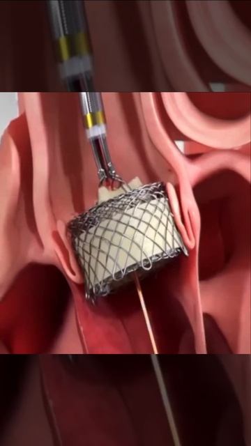 Схема замены аортального клапана смотреть онлайн