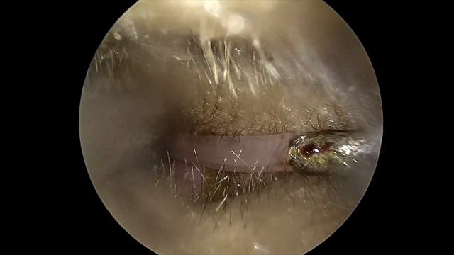 Ear Tube Placement (myringotomy)