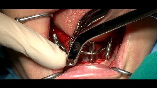 Here we present a “Weld_on_4 “case : смотреть онлайн