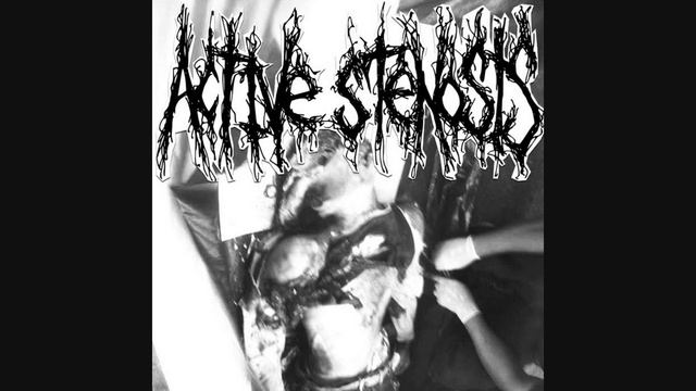 Active Stenosis - Rapid Decline (Construction Of Renal Artery)