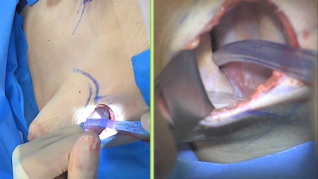 Breast Implant Exchange, Silicone Gel Implants: Live Streaming Plastic Surgery: Dr Michael Brown смотреть онлайн