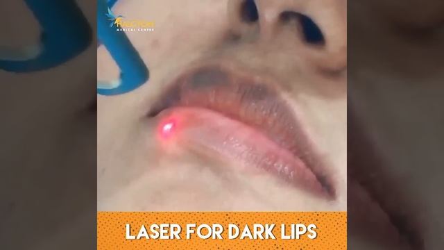 Laser for Dark Lips | Halcyon Medical Centre смотреть онлайн