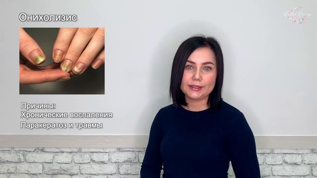 Урок 3.1 Онихолизис смотреть онлайн
