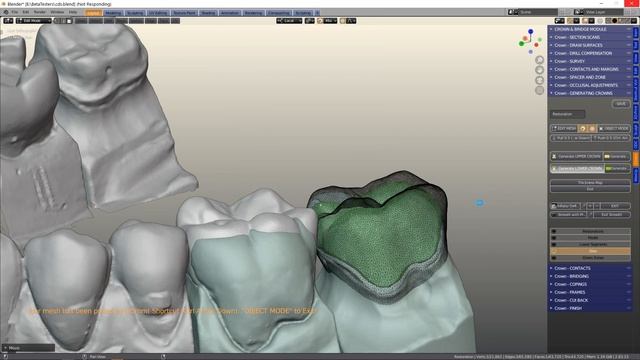 B4D Dental Modules- Onlays and Inlays смотреть онлайн