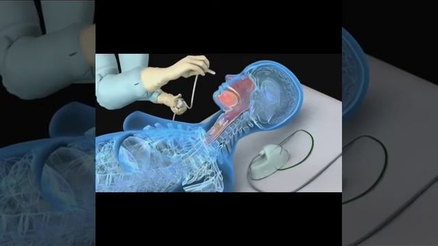 Suctioning Procedure | Healthcare Training | SMART Digital Learning | SMART BBSR