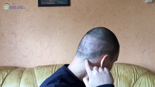 10 дней после пересадки волос на голове. Результат после операции по пересадке волос в Турции смотреть онлайн