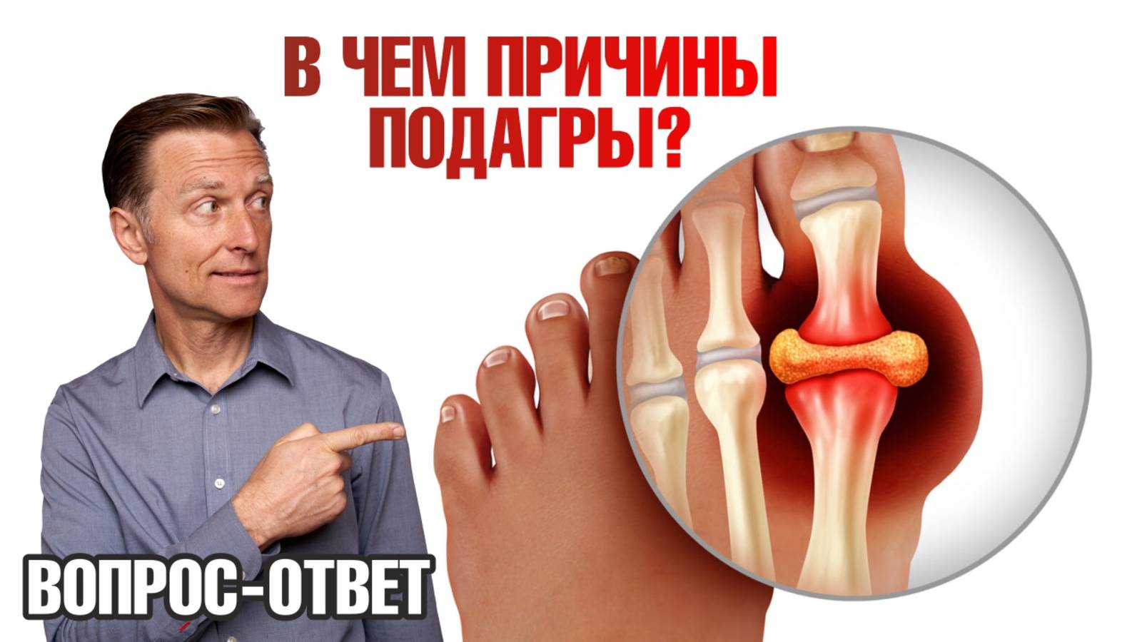 Приступы подагры. Альтернативный взгляд на причины подагры🧐 смотреть онлайн