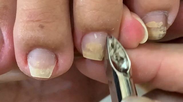 Remove Ingrown Nails Smoothly - Ingrown Toenail Removal - Free Time With Nail#109