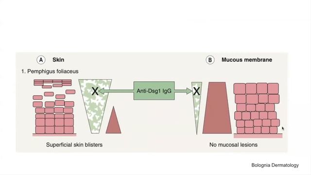 Desmoglein compensation hypothesis in Pemphigus (Autoimmune bullous diseases part 4) смотреть онлайн