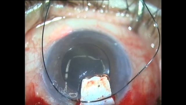 Canaloplastia Glaucolight Doble Hebra De Prolene 10:0