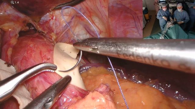 Revision After Sleeve Gastrectomy, GERD, Hiatal Hernia, Cardioplant* Wrapping