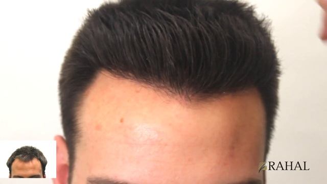 Who is the Top Hair Transplant Doctor in Canada - Dr. Rahal - 3455 Grafts Results смотреть онлайн
