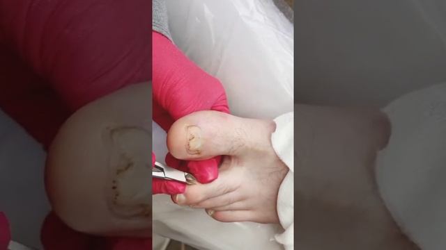 Обработка стержневой мозоли в Тбилиси - быстро и безболезненно смотреть онлайн