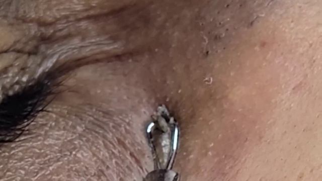 Blackhead extractions in 3 Patients in a single day | @Dr.AMAZINGSKIN смотреть онлайн