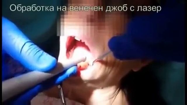 Лазерна стоматология смотреть онлайн
