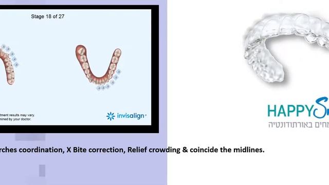 Happysmile case presentations Dr Galit Peleg Crwding, Cross Bite смотреть онлайн