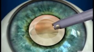 Как проводится операция по удалению катаракты — факоэмульсификация