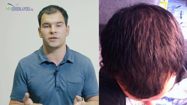 Моноксидил. Моя история до и после миноксидила. Minoxidil4you