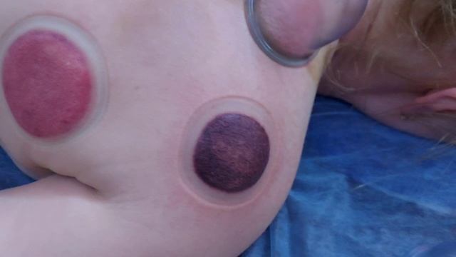 сухая хиджама смотреть онлайн