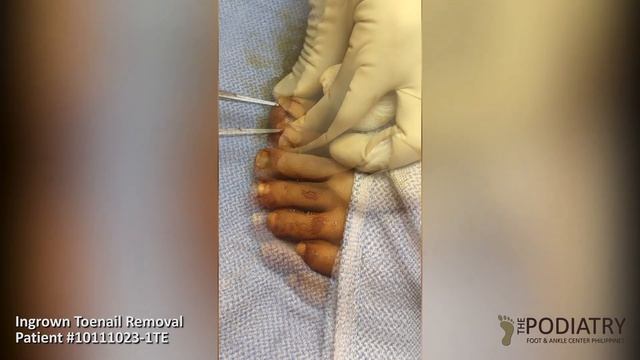 Ingrown Toenail Surgery.  Ingrown Toenails Can Be Painful And They Usually Worsen In Stages.