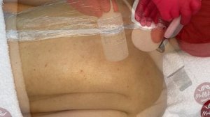 Ультразвуковая чистка спины + пилинг с пробиотиком INIT PROF