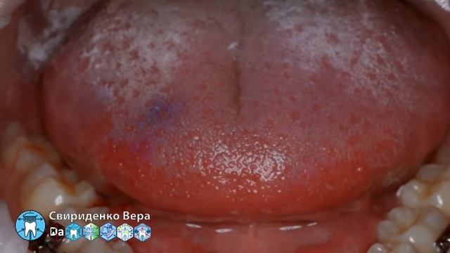 Профессиональная гигиена полости рта с бреетами DTE D7 LED (прямой эфир) смотреть онлайн