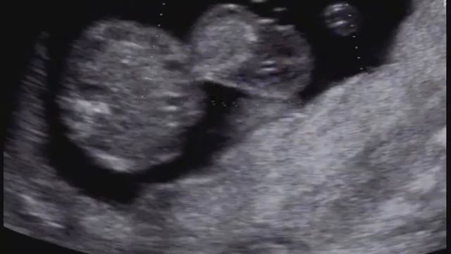 Onfalocele caso 19 смотреть онлайн