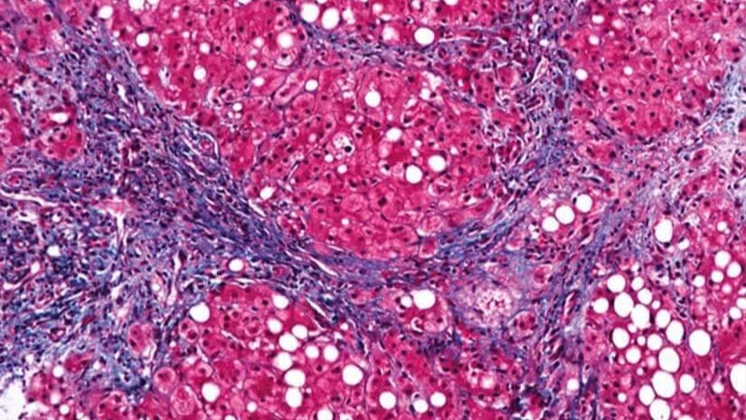 Патология печени смотреть онлайн