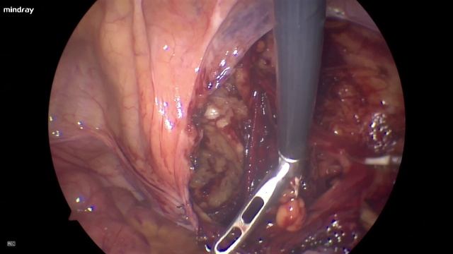 TAPP пластика паховой грыжи справа