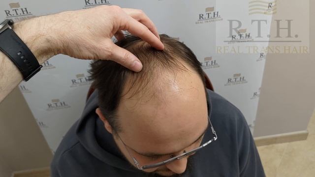 Степень облысения 5А☀️ смотреть онлайн