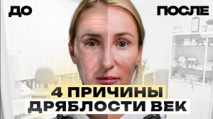 Как избавиться от ДРЯБЛОСТИ век? Топ причин ПТОЗА век