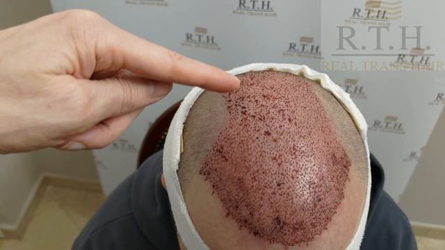 Как выглядит голова сразу после процедуры и через неделю смотреть онлайн