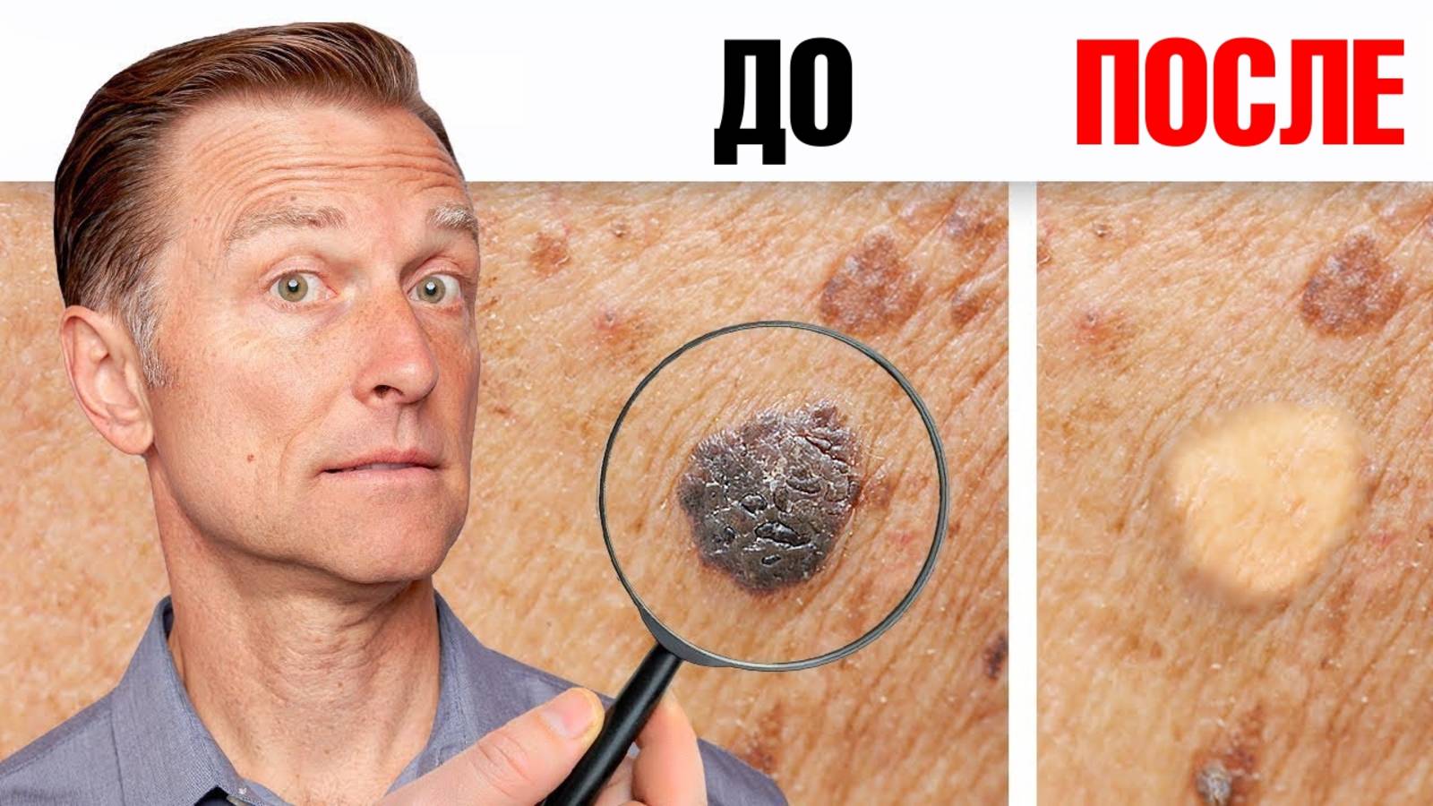 Как избавиться от папиллом и бородавок за ОДНУ ночь?👀 смотреть онлайн