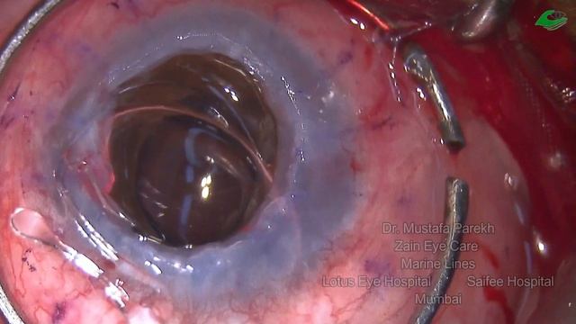 Dr. Mustafa Parekh - Pseudophakic Bullous Keratopathy - Iris Claw Implant смотреть онлайн