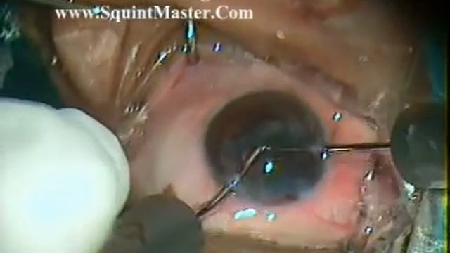 Phaco Cataract Surgery in Posterior Subcapsular Soft Cataract By Dr Sudhir Singh смотреть онлайн